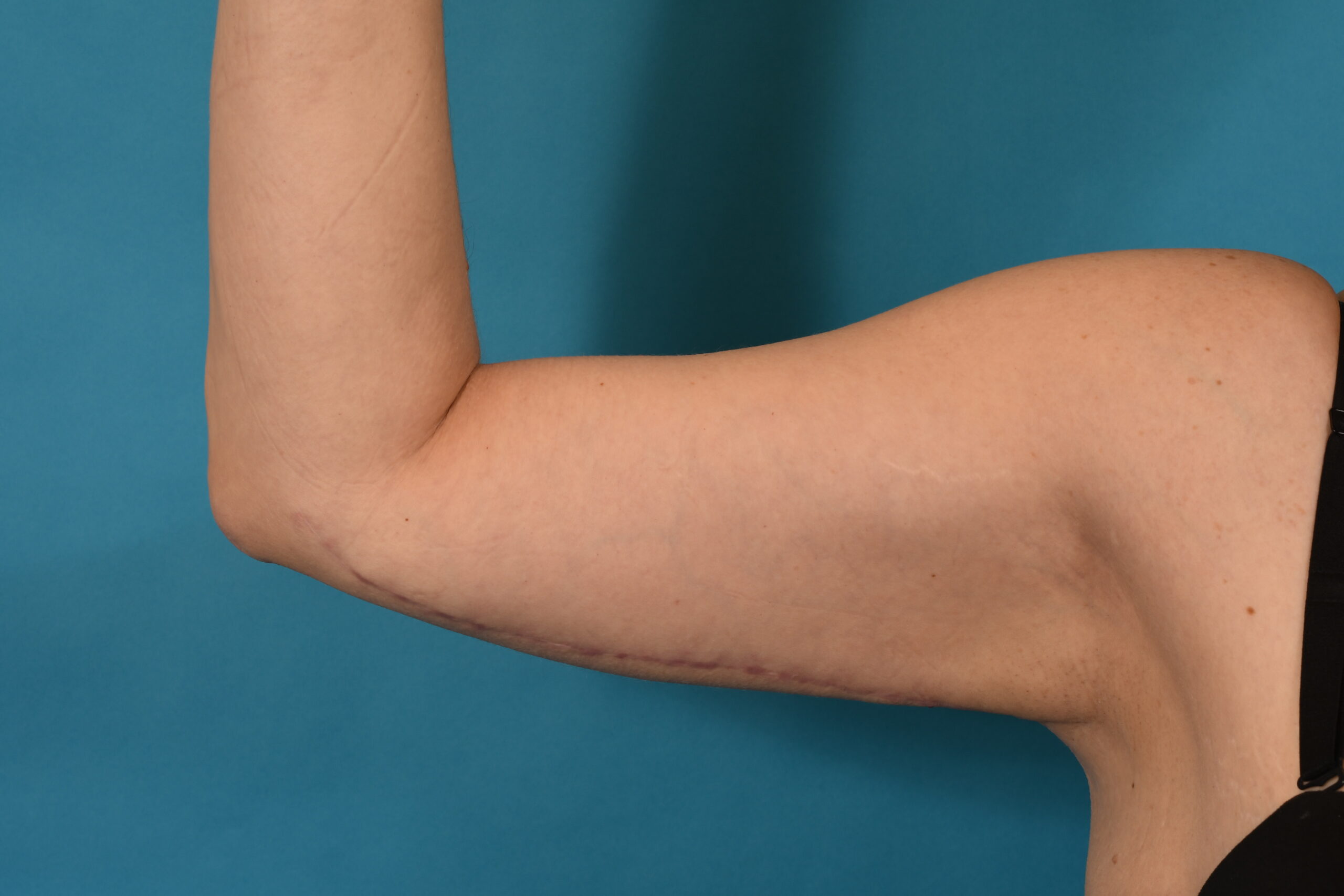 Arm Lift before — Dr. Denis Branson