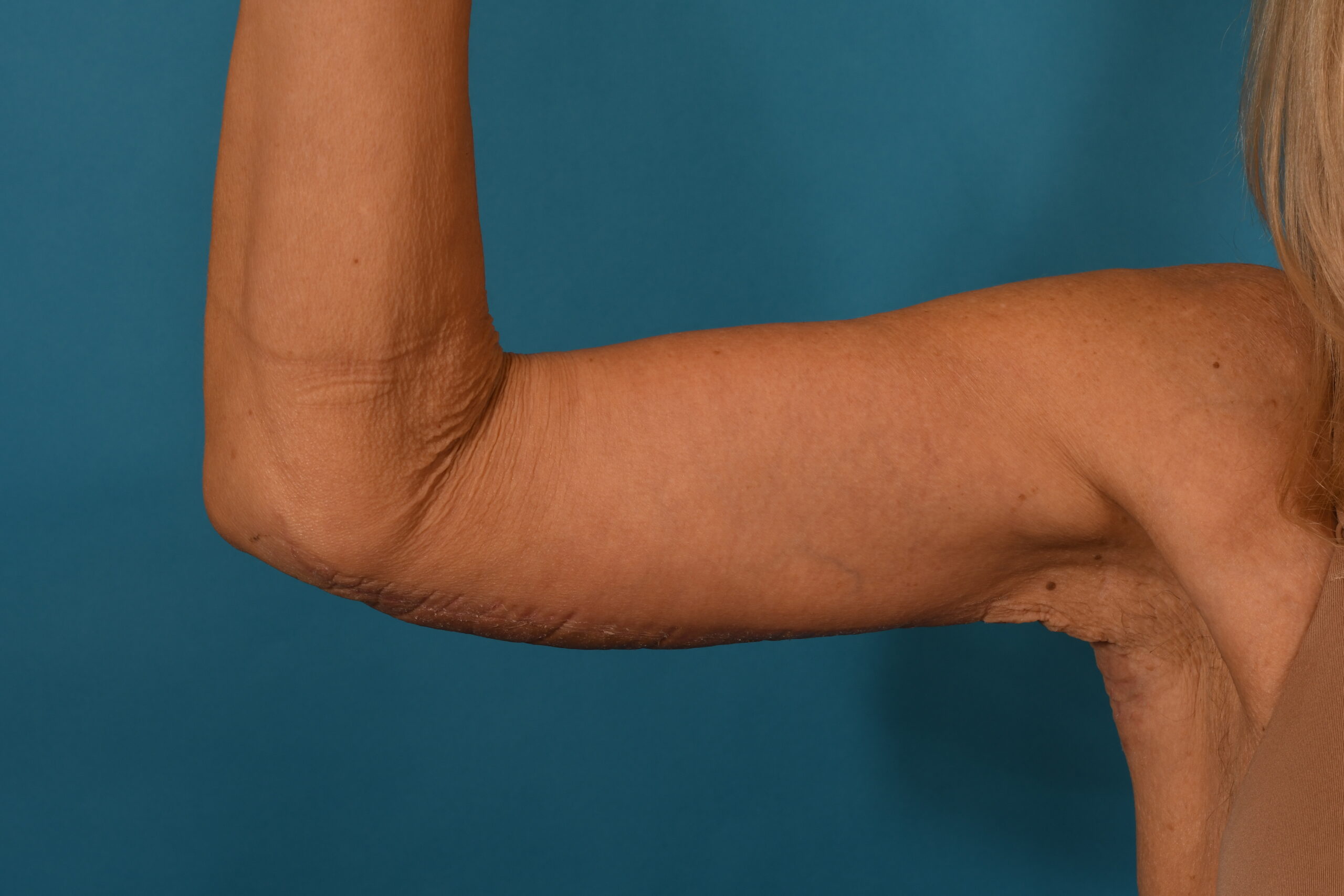 Arm Lift before — Dr. Denis Branson