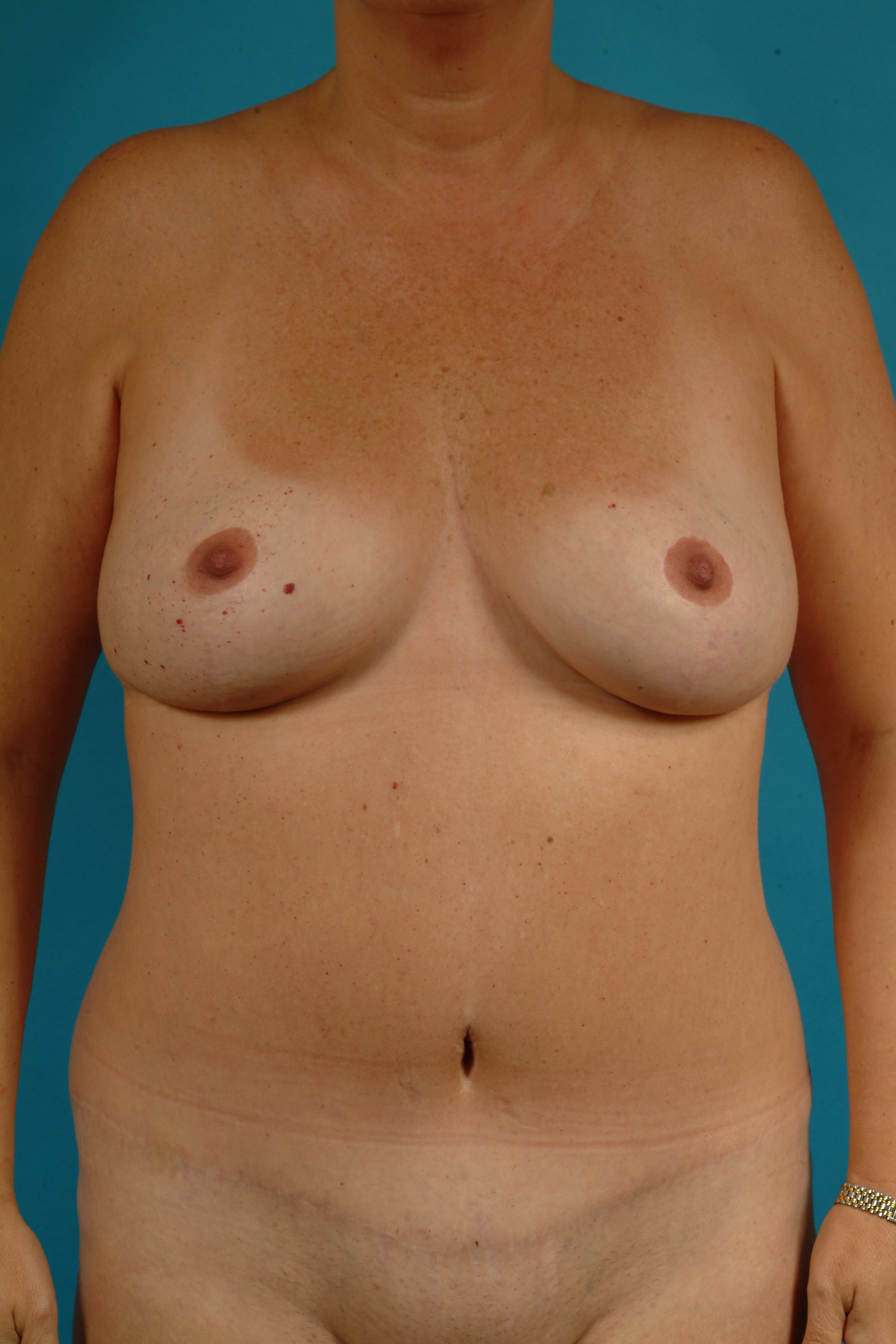 Mommy Makeover before and after - before