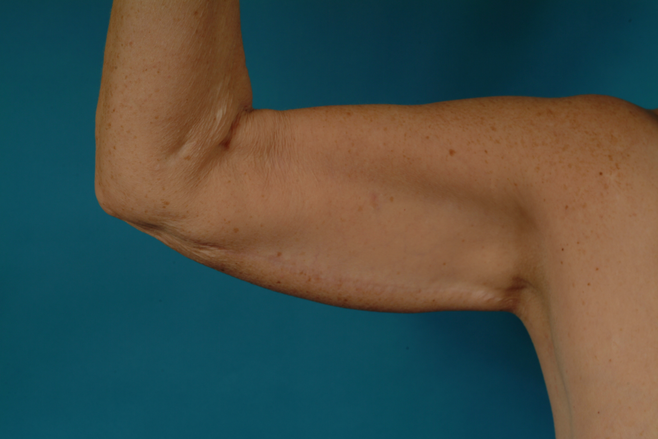 Arm Lift before — Dr. Denis Branson