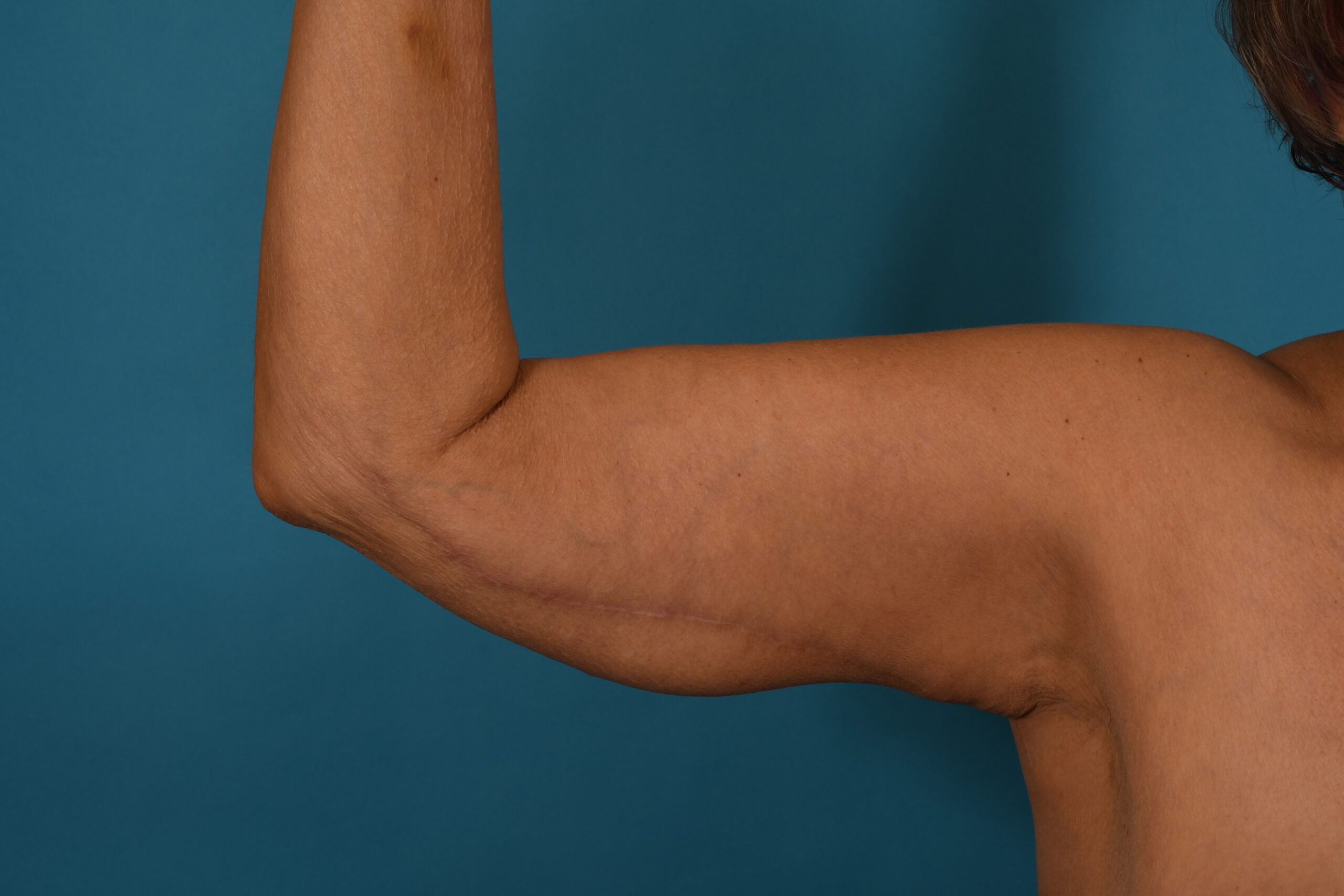 Arm Lift before — Dr. Denis Branson