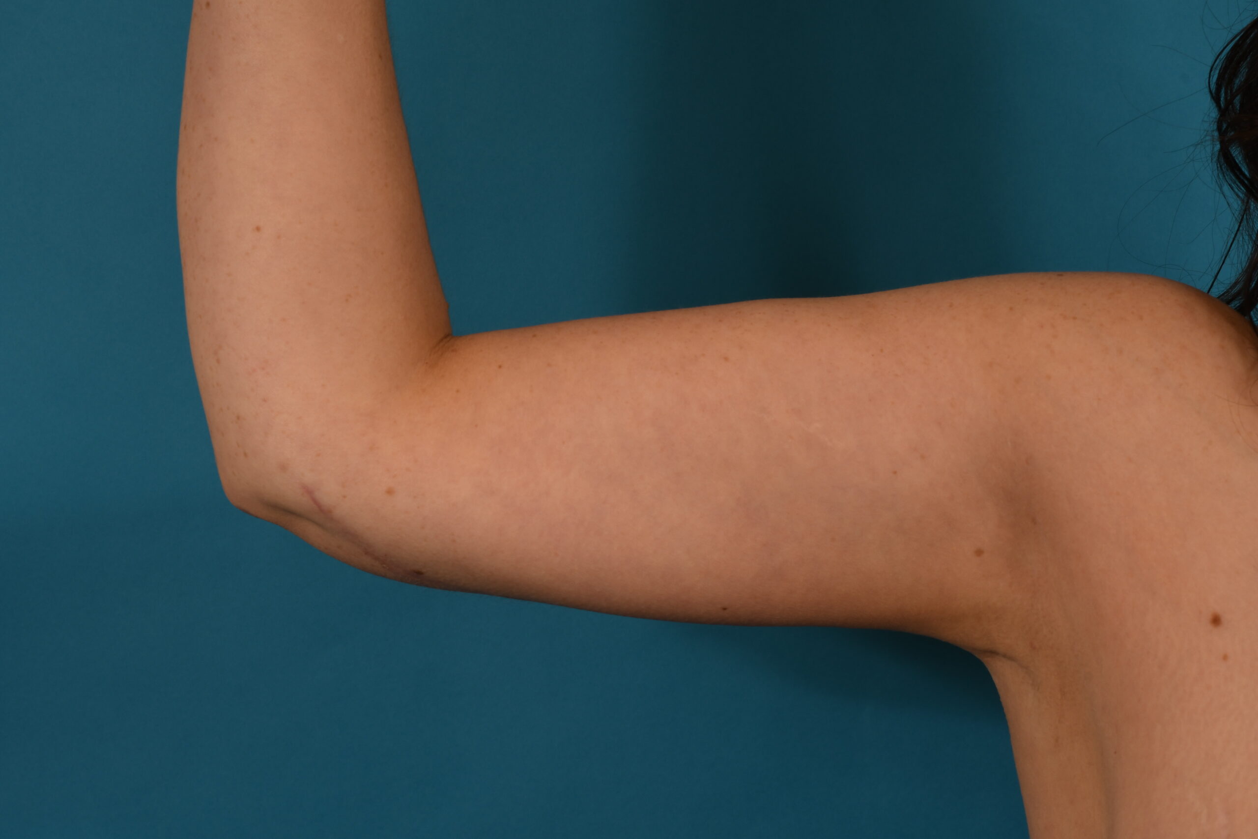 Arm Lift before — Dr. Denis Branson