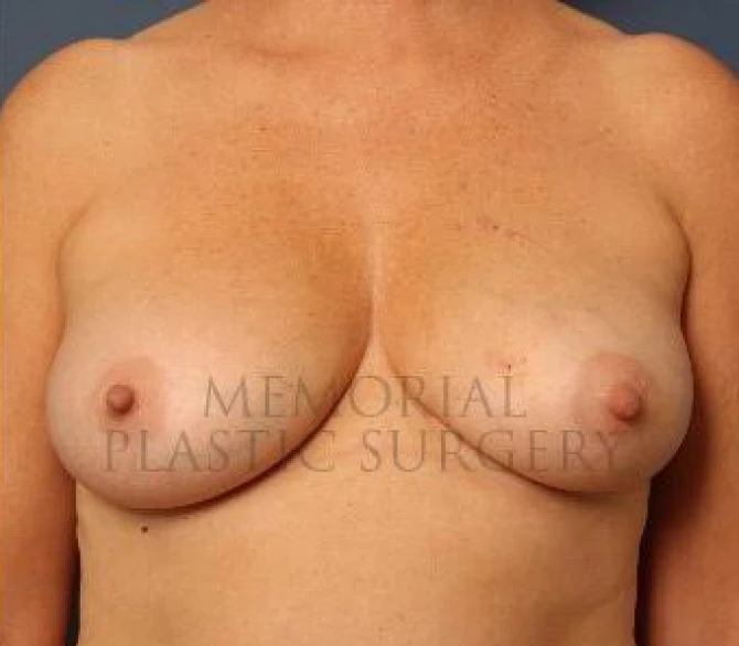 Procedure before and after - after