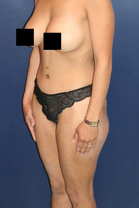 Mommy Makeover before and after - after