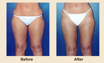 Liposuction/Liposculpture before and after - after