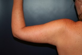 Liposuction before and after - after