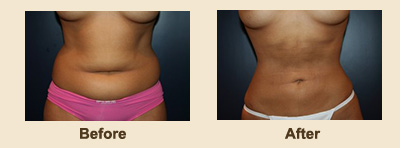 Liposuction/Liposculpture before and after - after