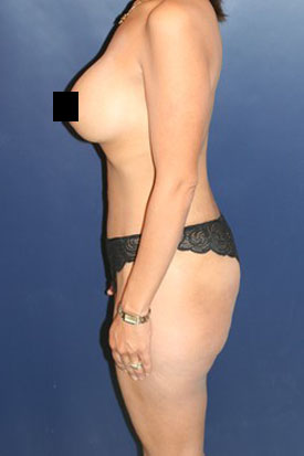 Mommy Makeover before and after - after