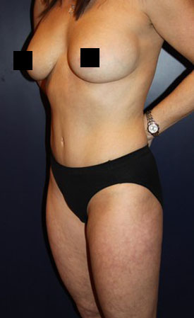 Mommy Makeover before and after - after