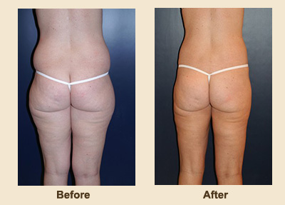 Liposuction/Liposculpture before and after - after