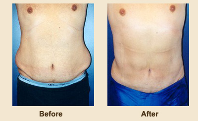 Liposuction/Liposculpture before and after - after