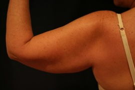 Liposuction before and after - before