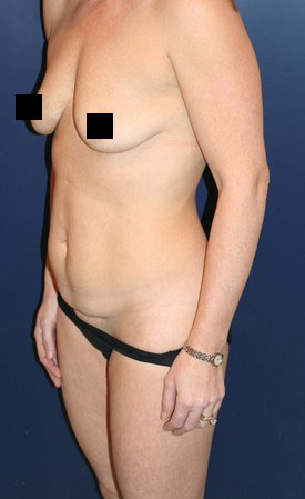 Mommy Makeover before and after - before