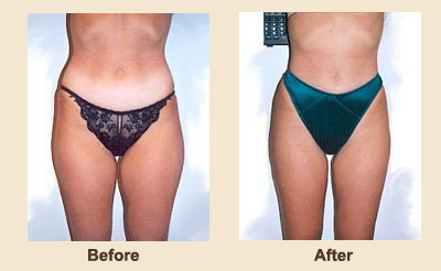 Liposuction/Liposculpture before and after - before