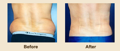Liposuction/Liposculpture before and after - before