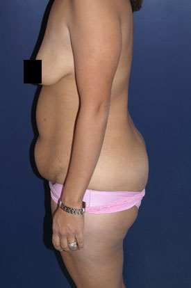 Mommy Makeover before and after - before