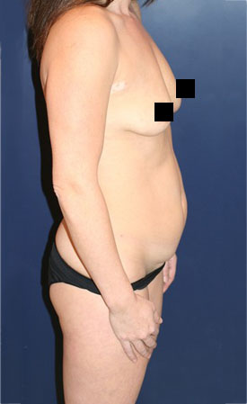 Mommy Makeover before and after - before