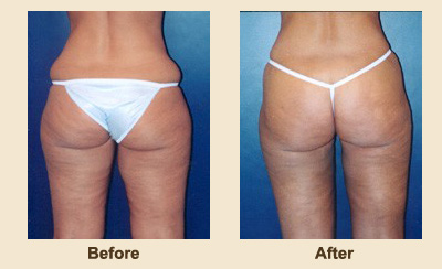 Liposuction/Liposculpture before and after - before