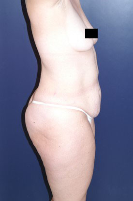 Mommy Makeover before and after - before