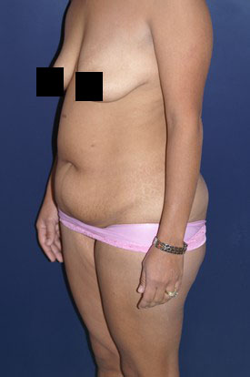 Mommy Makeover before and after - before
