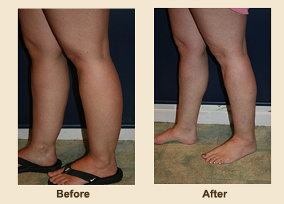 Liposuction/Liposculpture before and after - before