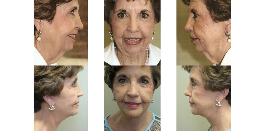 Rhinoplasty before and after - after