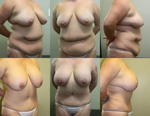 Mommy Make-Over(Abdominoplasty, Breast Augmentation, and Mastopexy) before and after - after