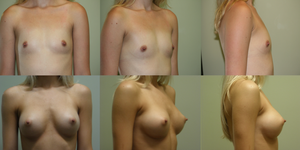 Breast Augmentation - Shaped Silicone before and after - after