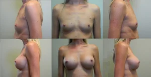 Breast Augmentation - Shaped Silicone before and after - before