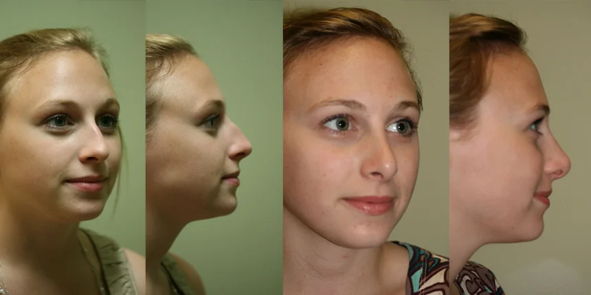 Rhinoplasty before and after - before