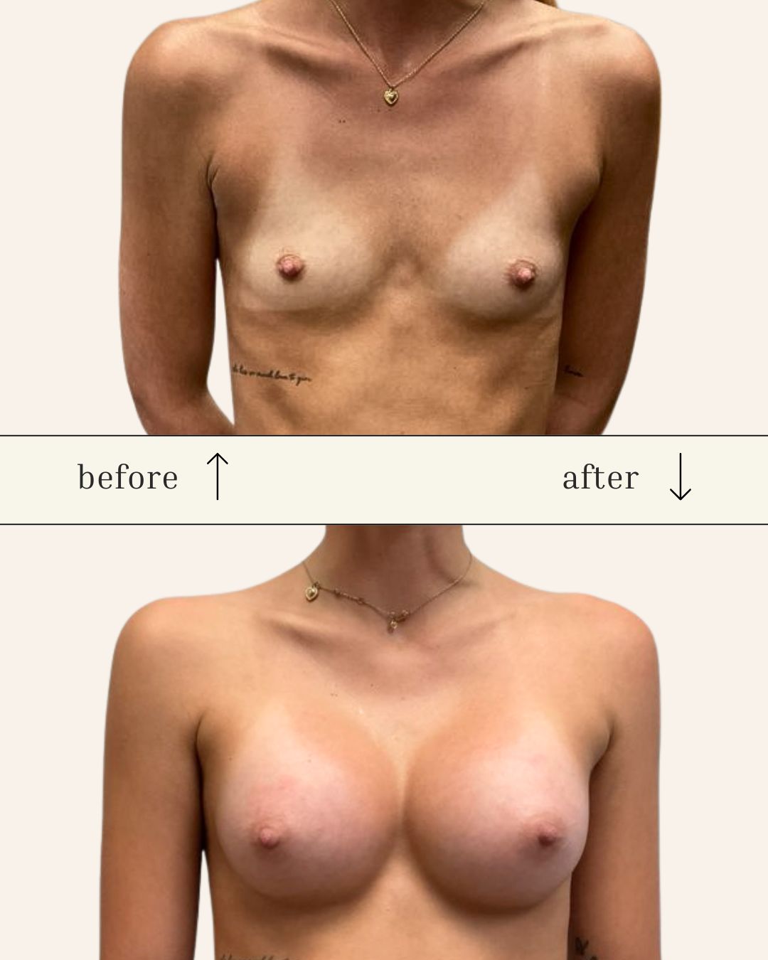 Scarless Breast Augmentation before and after - after