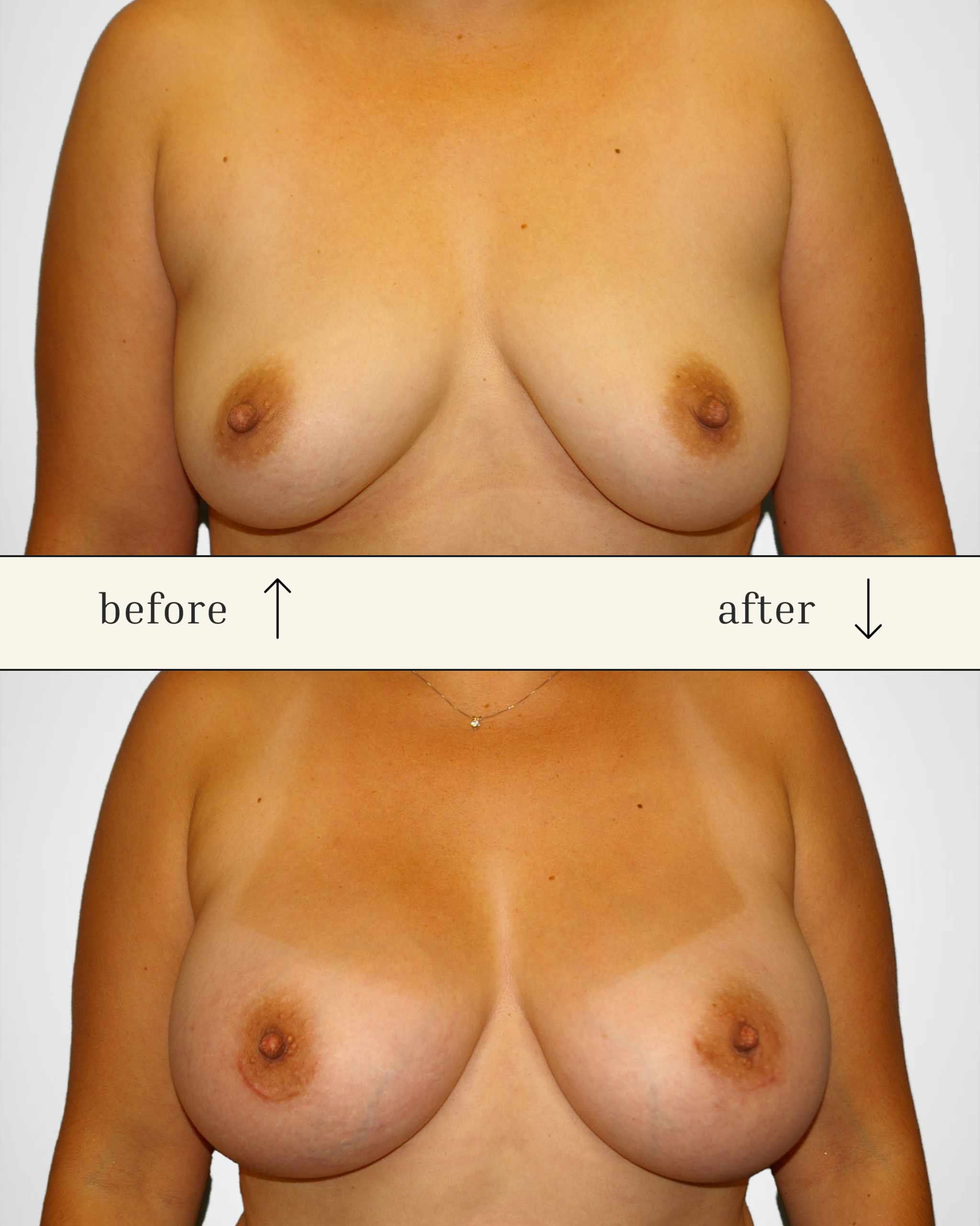Breast Augmentation before and after - after