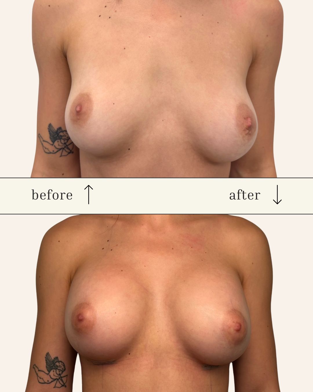 Breast Augmentation before and after - after