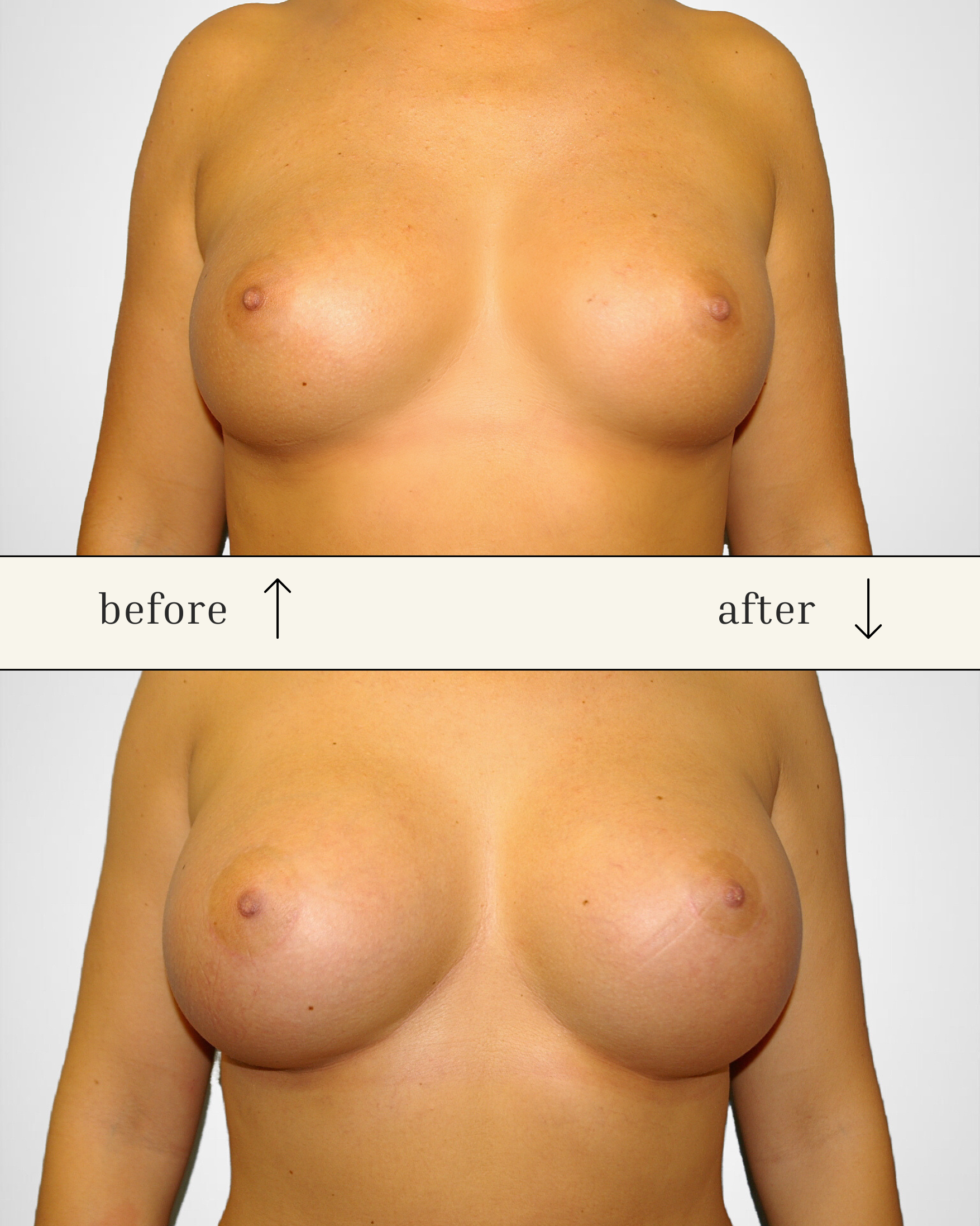 Breast Augmentation before and after - after