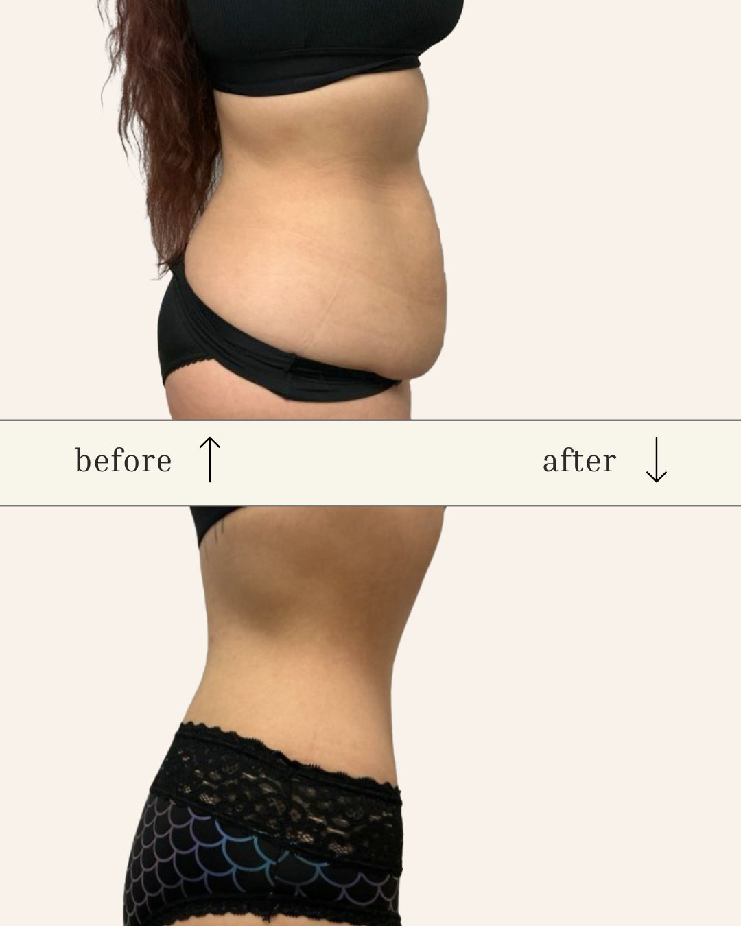 Tummy Tuck before and after - after