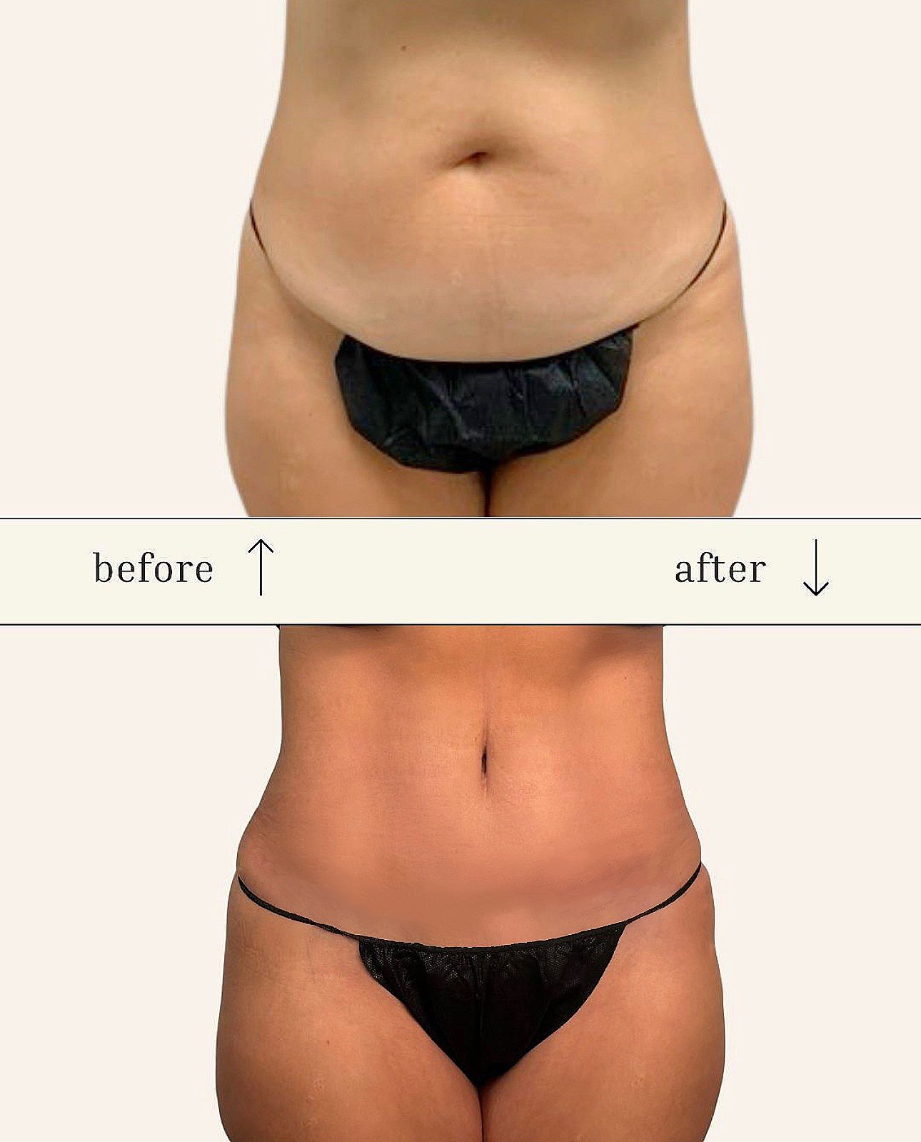 Tummy Tuck before and after - after
