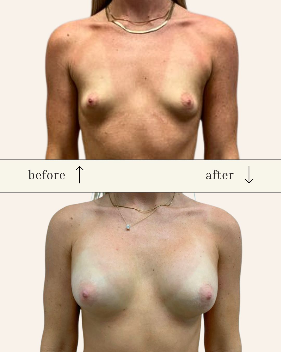 Scarless Breast Augmentation before and after - after