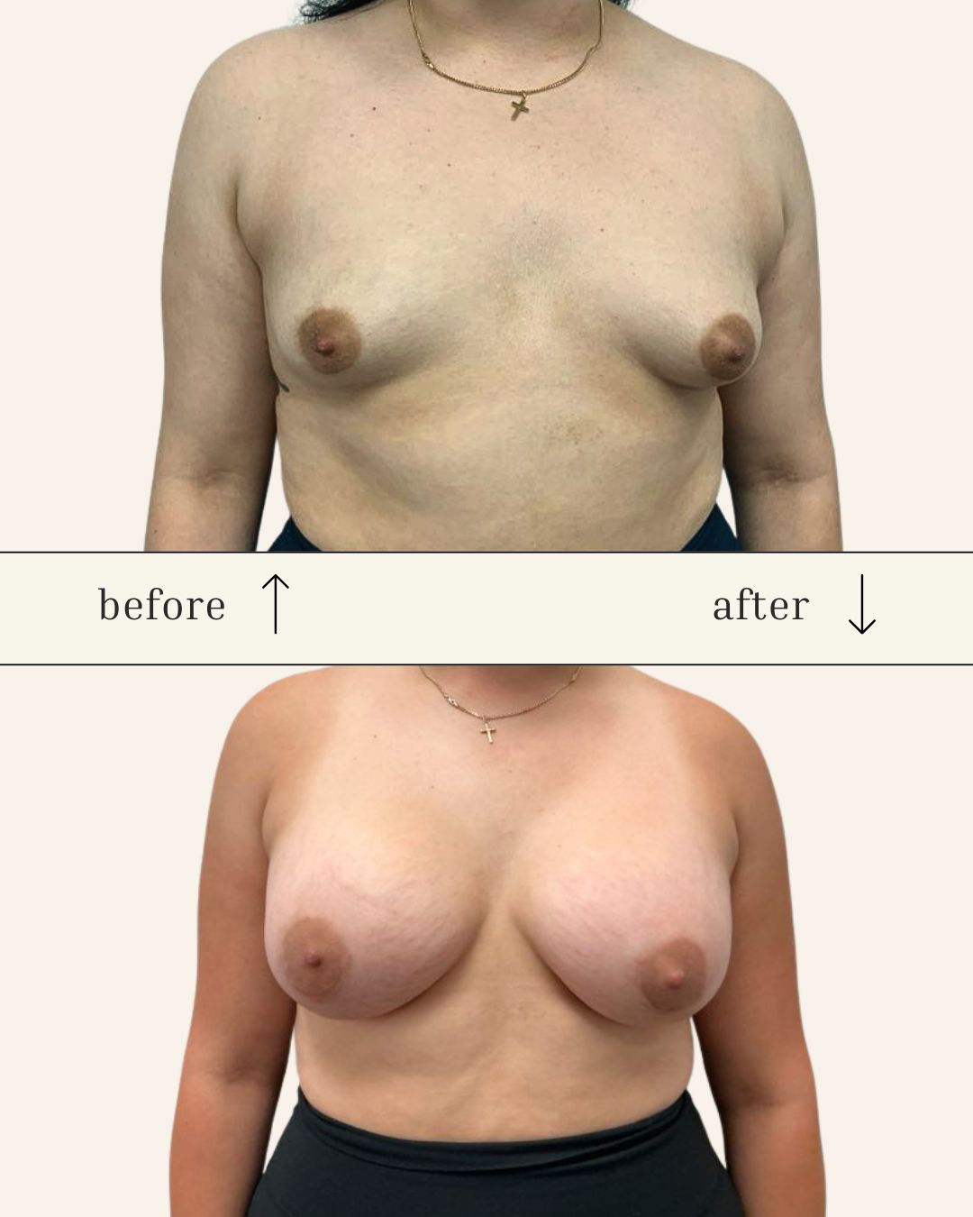 Breast Augmentation before and after - before