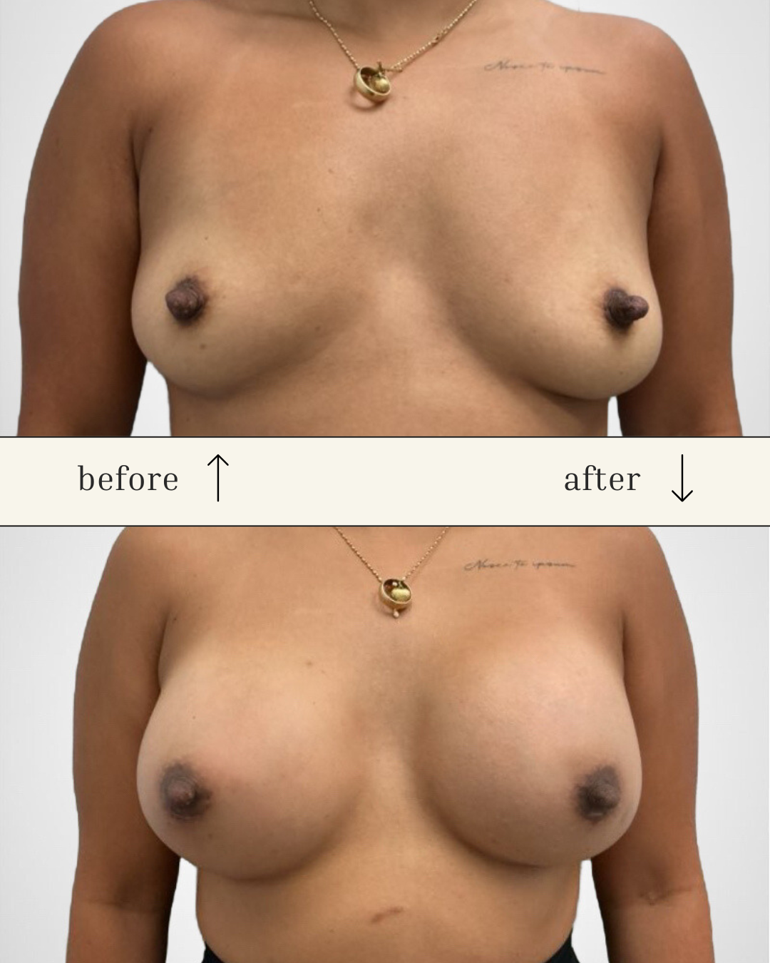 Breast Augmentation before and after - before