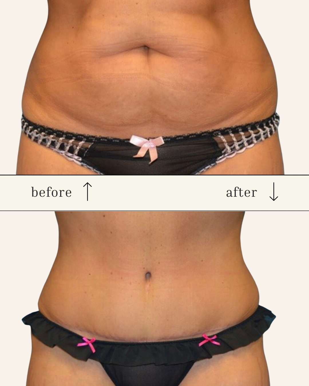 Tummy Tuck before and after - before