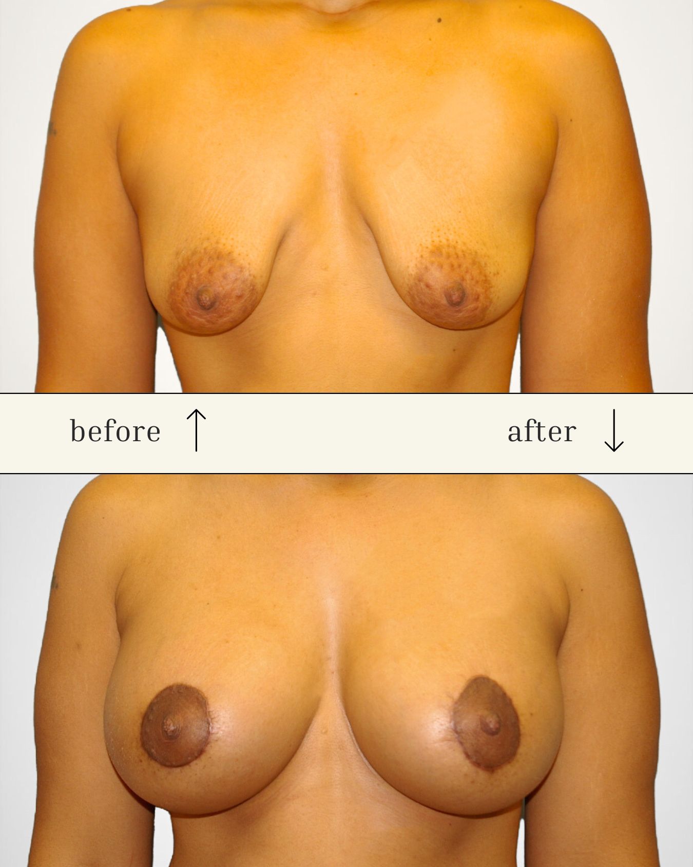 Breast Augmentation before and after - before