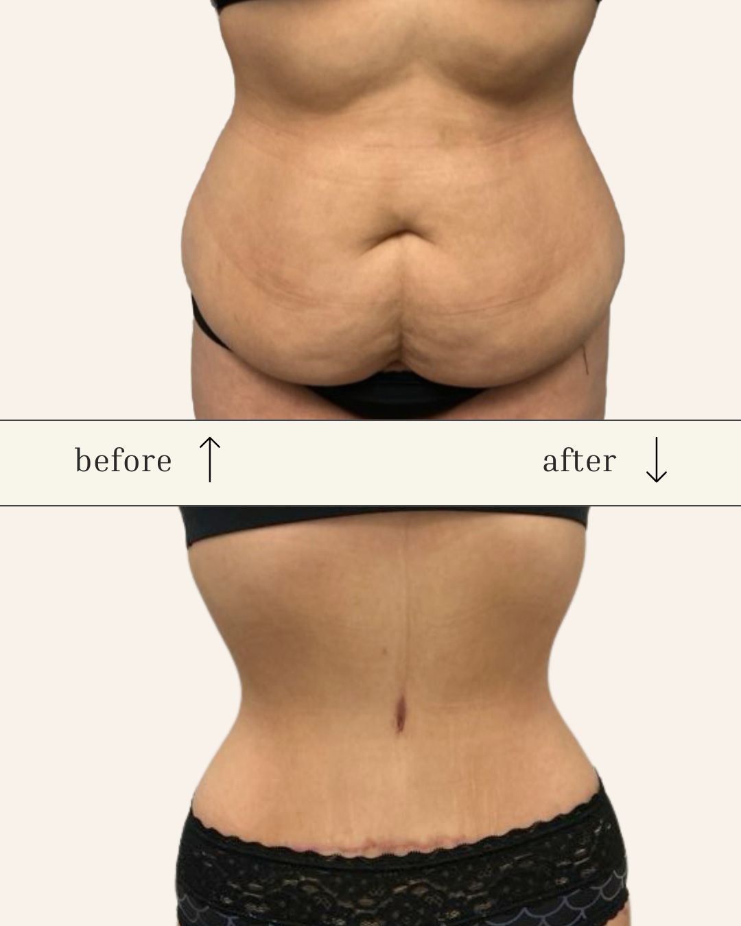 Tummy Tuck before and after - before