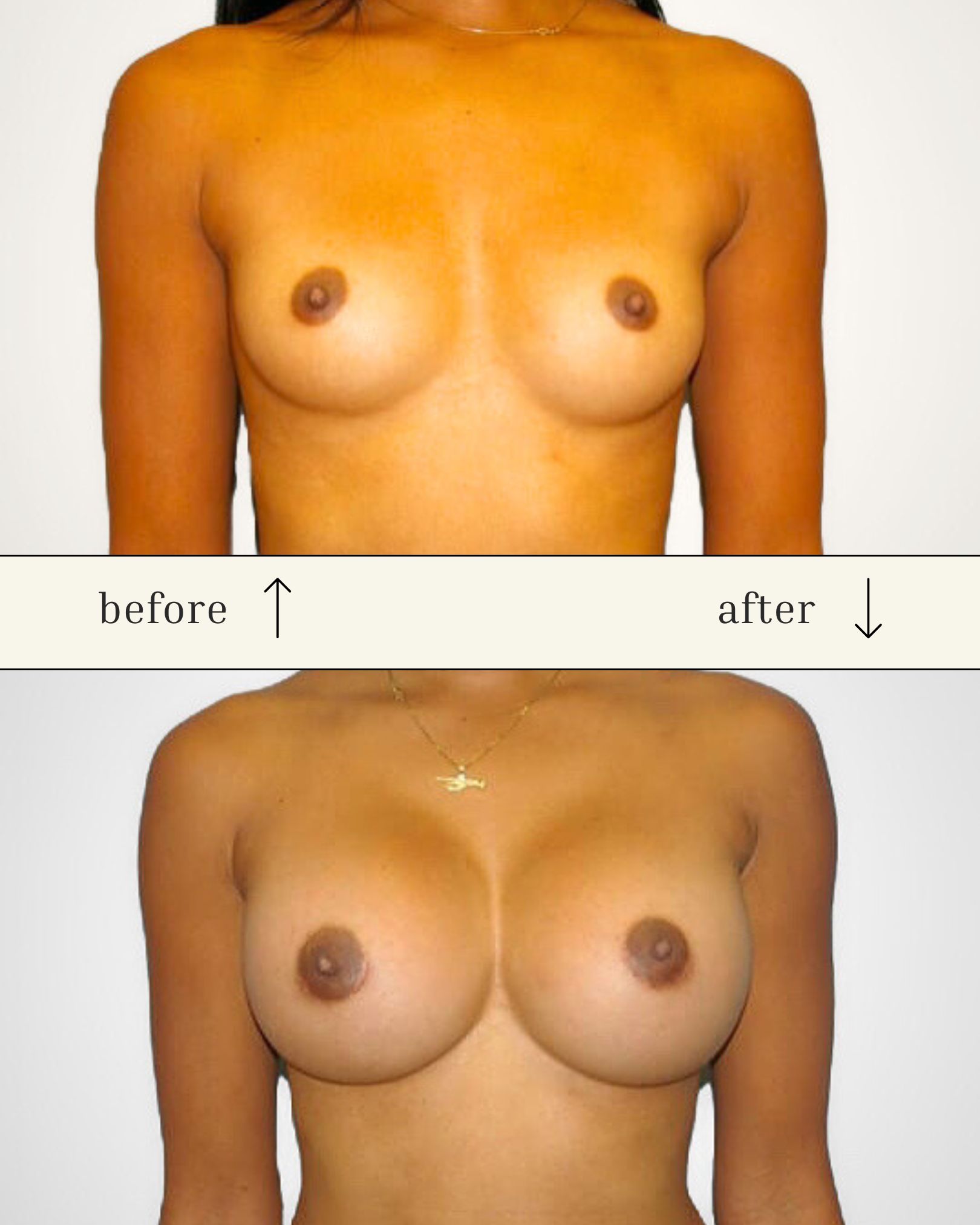 Breast Augmentation before and after - before
