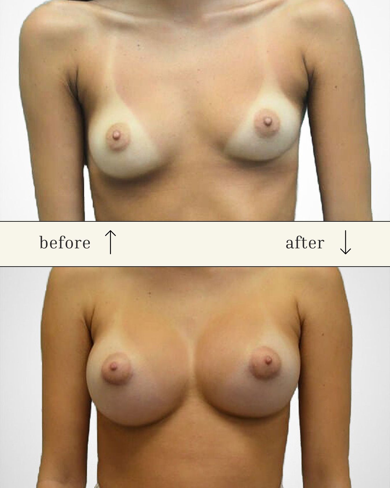 Breast Augmentation before and after - before