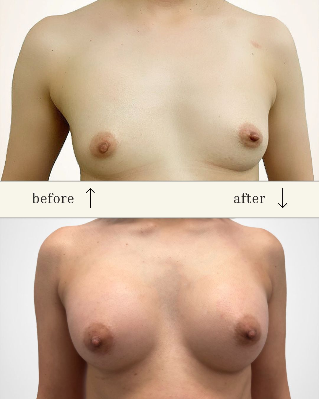 Scarless Breast Augmentation before and after - before