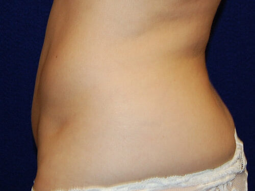 Liposuction before and after - after