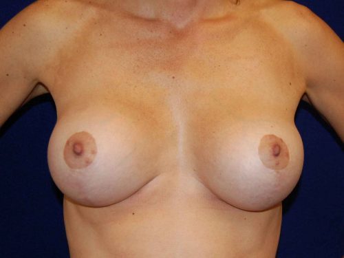 Breast Lift before and after - after