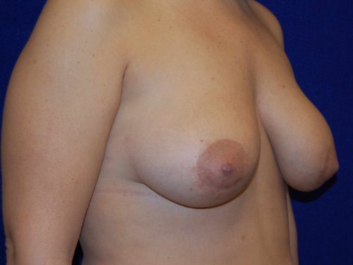Procedure before and after - after