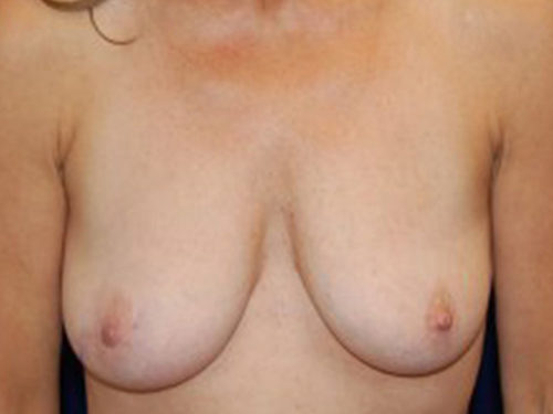 Breast Augmentation before and after - after