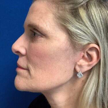 Facelift before and after - after